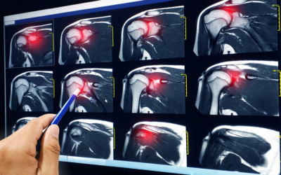 Treating Partial Rotator Cuff Tears